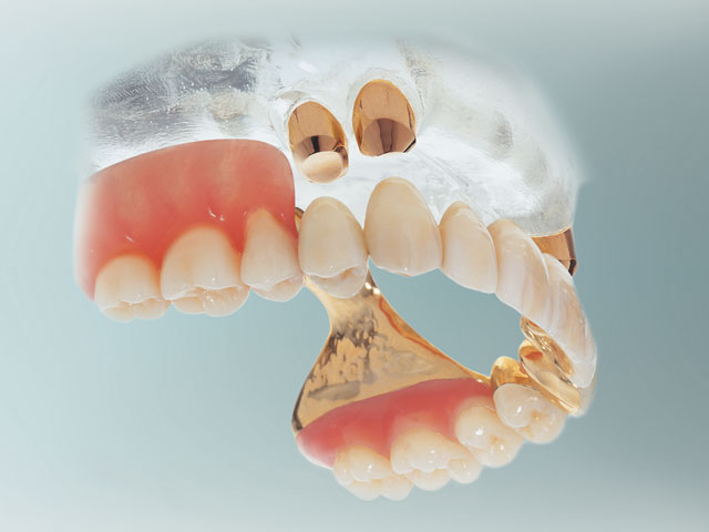 Herausnehmbare Teleskopprothese bei fehlenden Zähnen