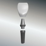 Implantatkrone - Zahnimplantat Aufbau - Zahnarztpraxis Dr. Witteler & Steinker
