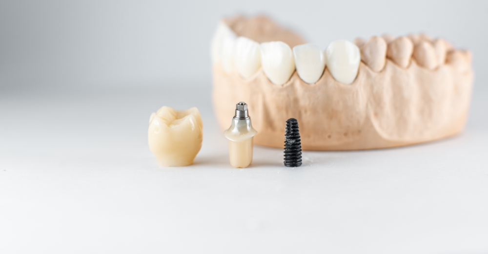 Zahnimplantate in Münster: Nahaufnahme eines Modellkiefers mit einem dentalen Implantat davor vor weißem Hintergrund
